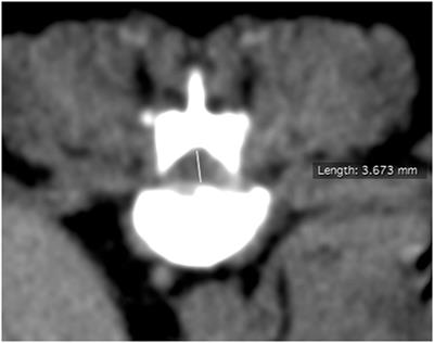 Residual Spinal Cord Compression Following Hemilaminectomy and Mini-Hemilaminectomy in Dogs: A Prospective Randomized Study